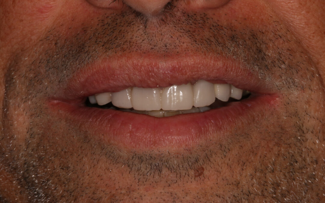 Rehabilitación oral completa: del implante unitario al tratamiento integral