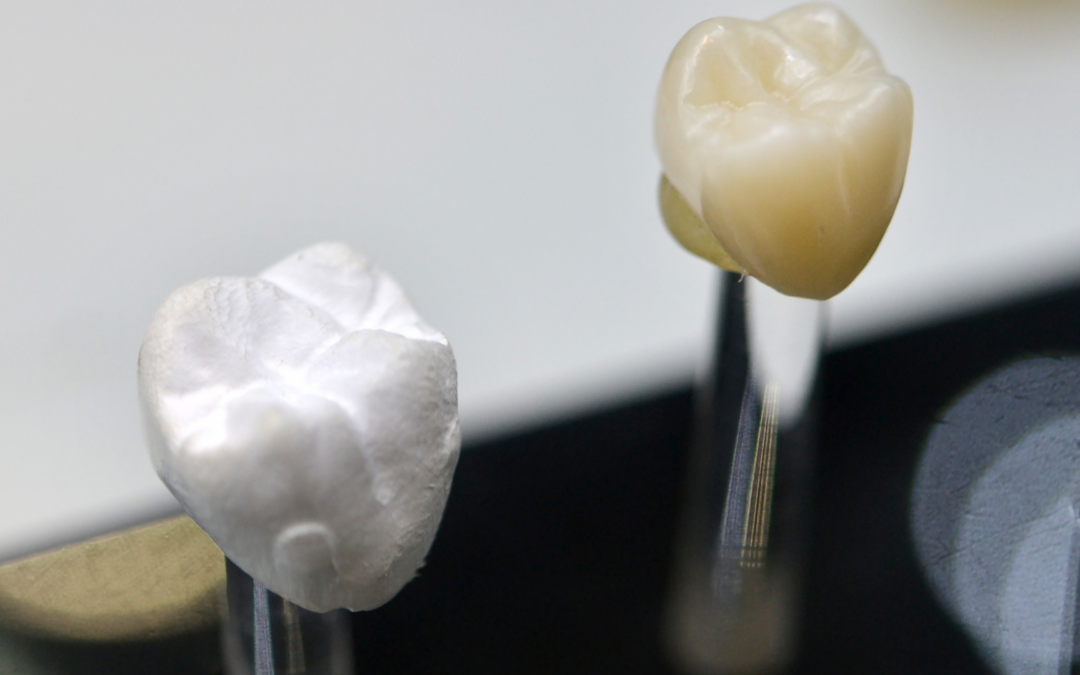 Sensibilidad con coronas dentales y carillas: cuándo una rehabilitación estética necesita revisión