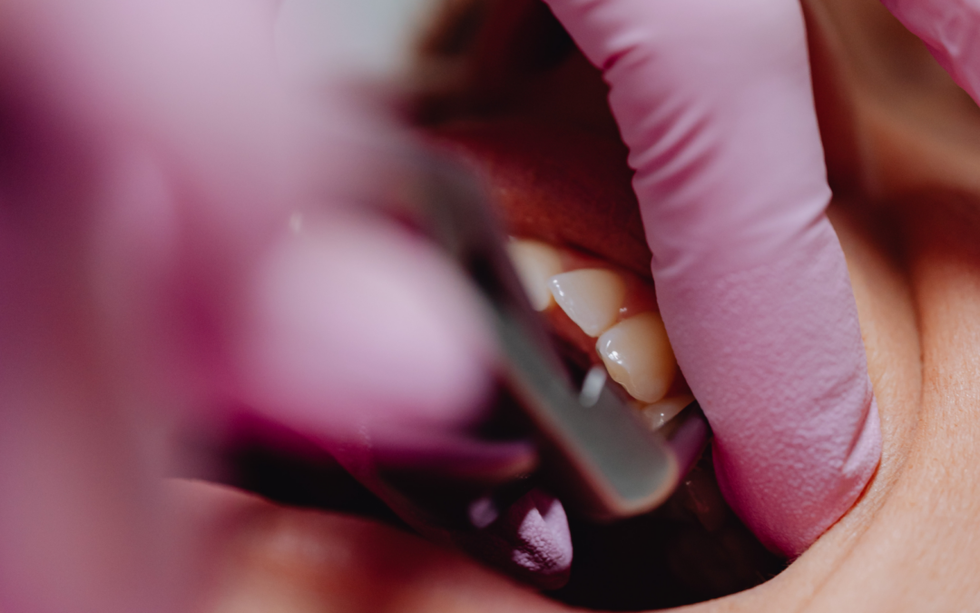 ¿Por qué se aflojan los dientes? Causas, diagnóstico y tratamiento periodontal